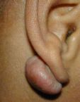 keloid2.gif