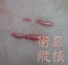 keloid.gif